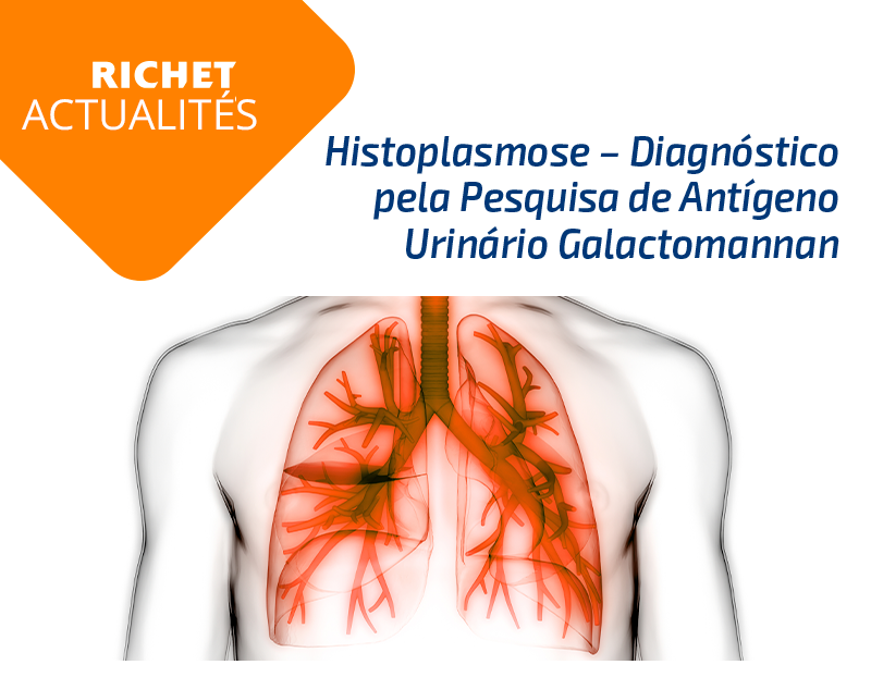 Richet Actualites. Histoplasmose – Diagnóstico pela Pesquisa de Antígeno Urinário Galactomannan